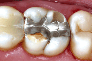 Heavy metal from dental work health effects